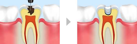 削らない虫歯治療　ドックベストセメント療法