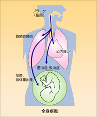 歯周病はお口だけではなく全身への影響も