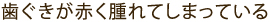 歯ぐきが赤く腫れてしまっている